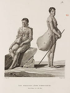 10436404
&copy; Science Museum Library
Tubercular leprosy sufferers, Mariana Islands, 1817-1820.