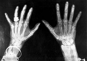 10413131
&copy; Science Museum Library
X-rays of the hands of King George and Queen Mary, 1896.