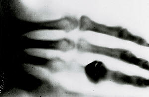 10288963
&copy; Science Museum
Roentgen's X-ray photograph, 1895.
