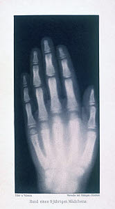 10319367
&copy; NMeM
Hand of an eight year old girl, 1896.