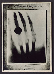 10456380
&copy; Science Museum
Radiograph of a hand with a ring, 1895.